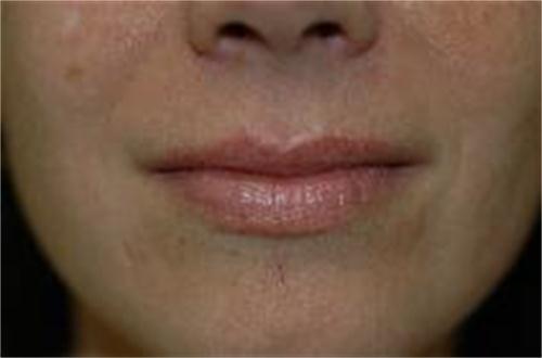 Fillers 1